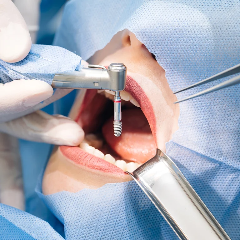 Dental Implant Healing Stages: What to Expect Week by Week