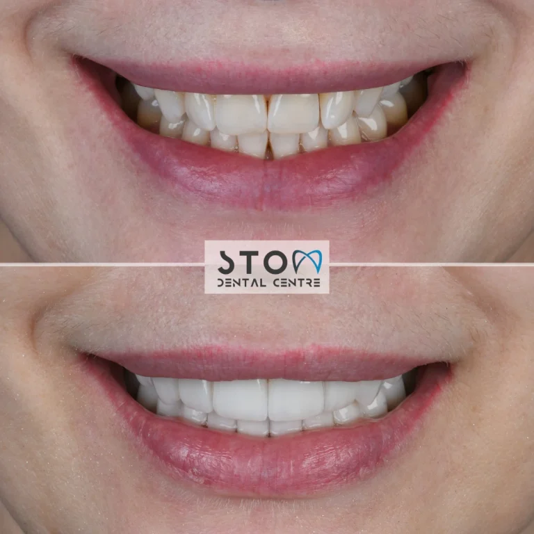 Gummy Smile Treatment: Gum Contouring, Lip Repositioning and Other Options