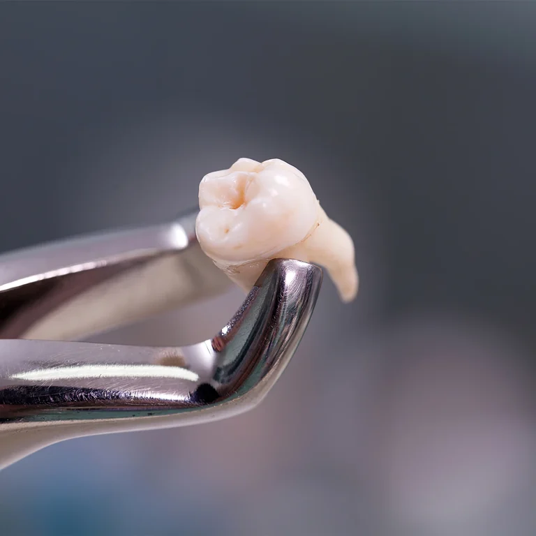 Flying After Dental Surgery: How Soon Is It Safe?
