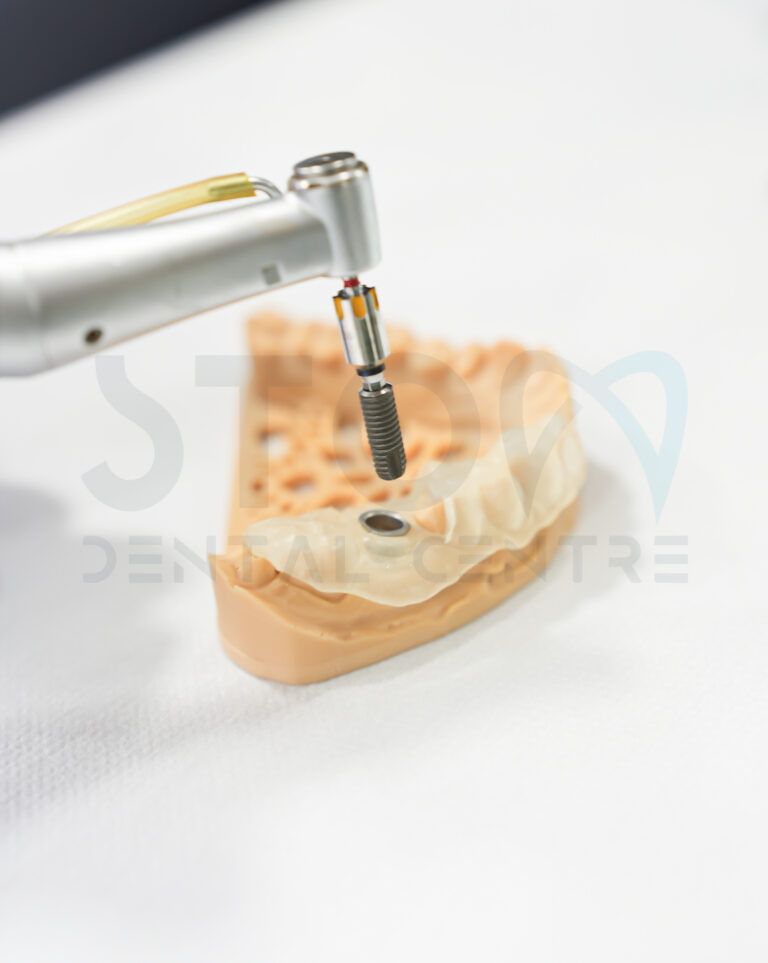 Missing Tooth: Implant vs Bridge vs Denture, and What the Data Show