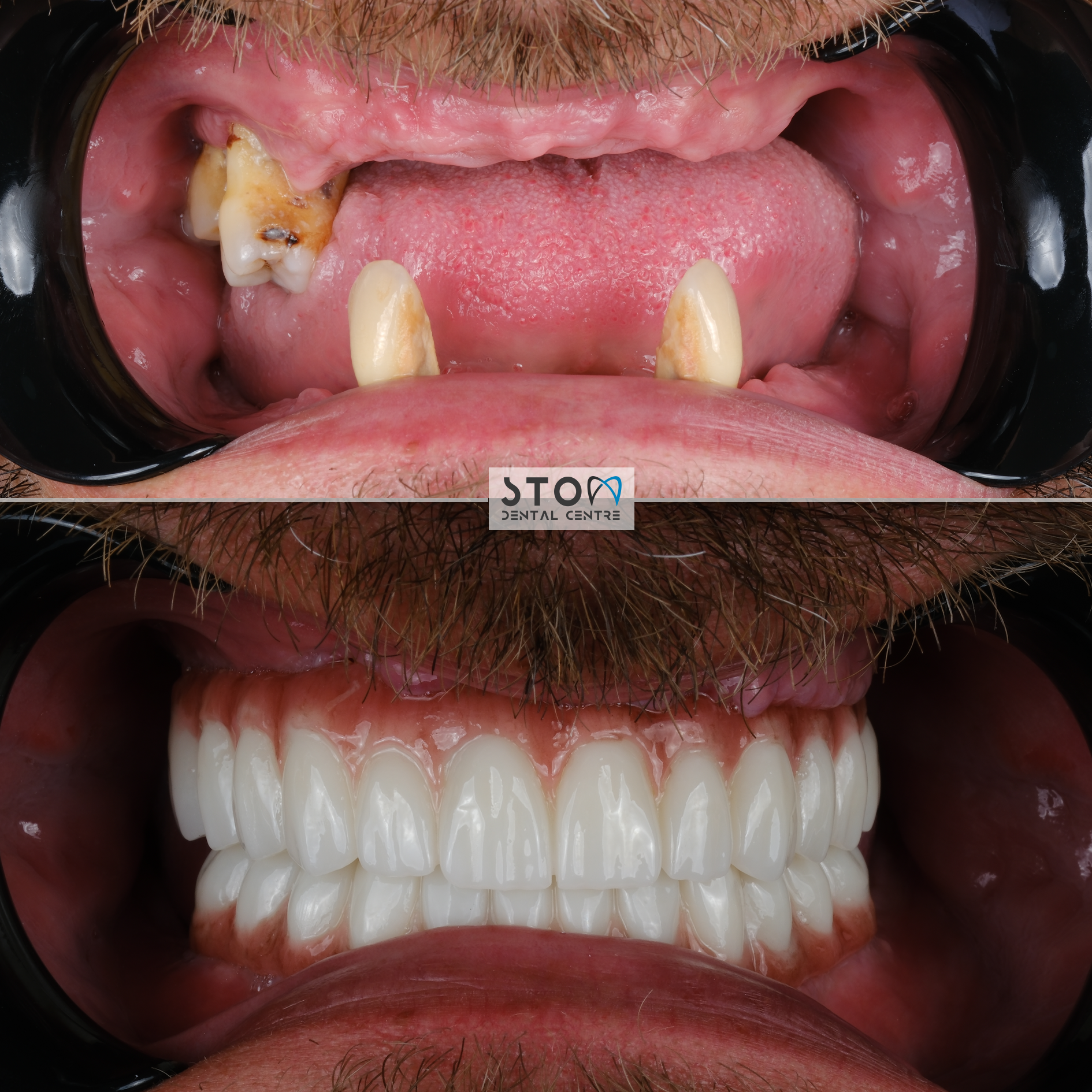 All-on-4 dental implants before and after transformation at Stom Dental Centre Antalya Turkey
