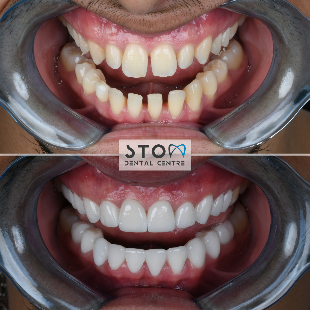 Before and after dental calculus cleaning at Stom Dental Centre Antalya