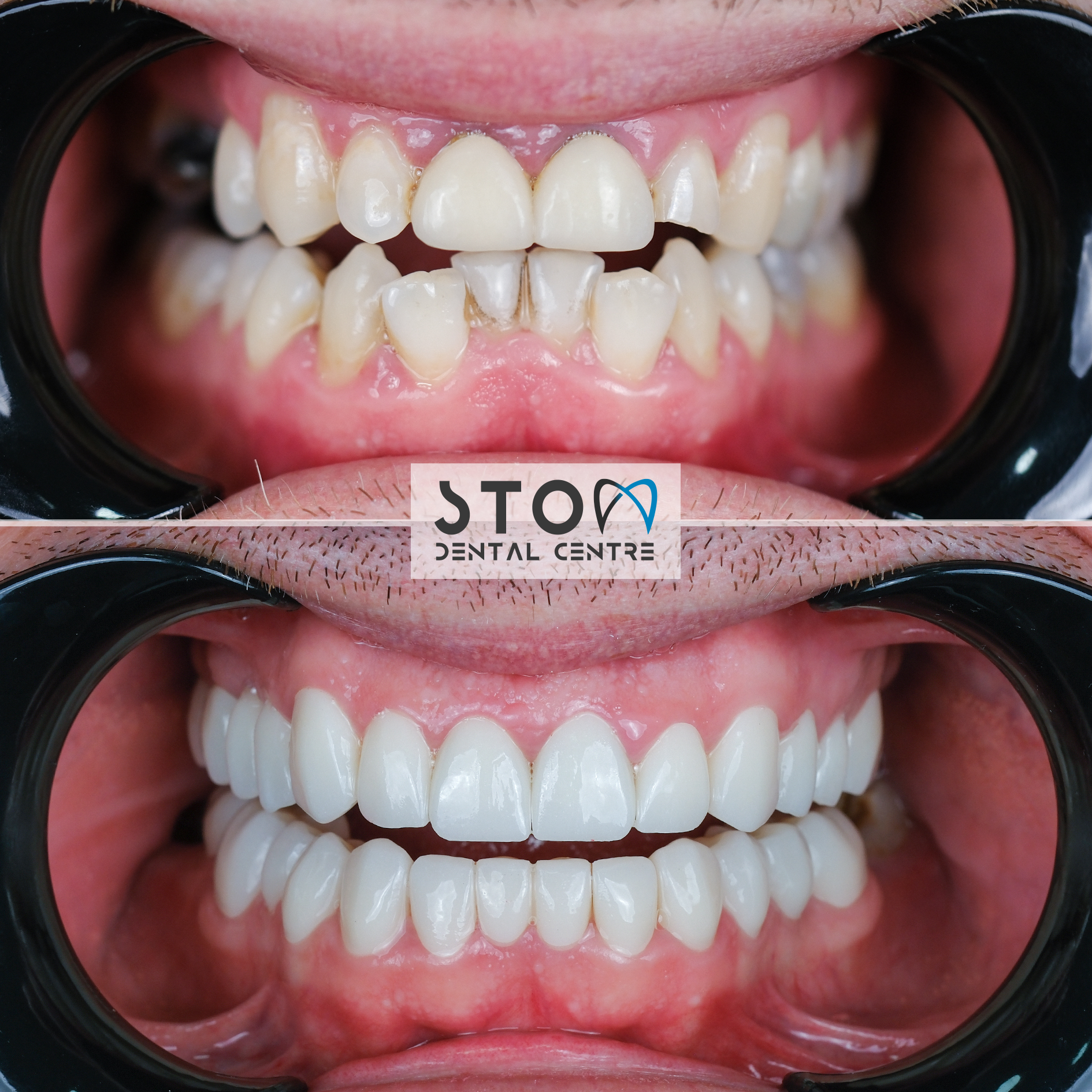 Hollywood smile veneer before and after at Stom Dental Centre Antalya