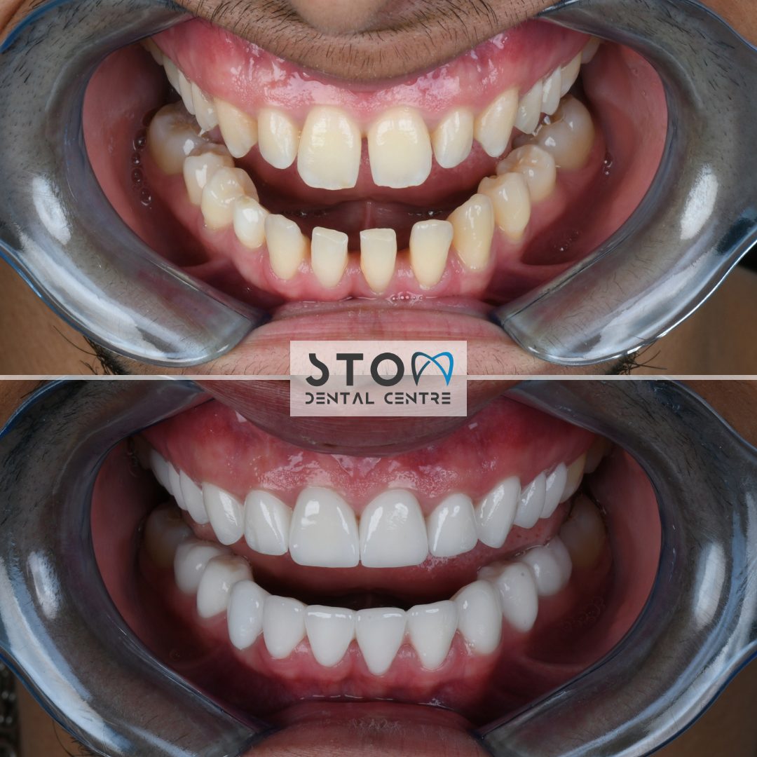 Veneers — Real Results
