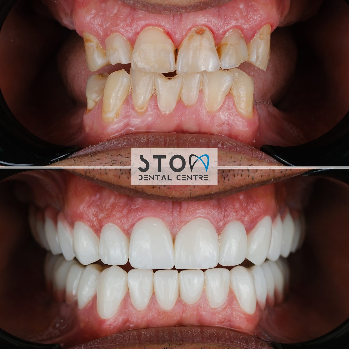 Full Mouth Reconstruction — Real Results