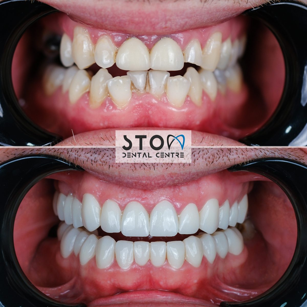 Hollywood Smile — Real Results