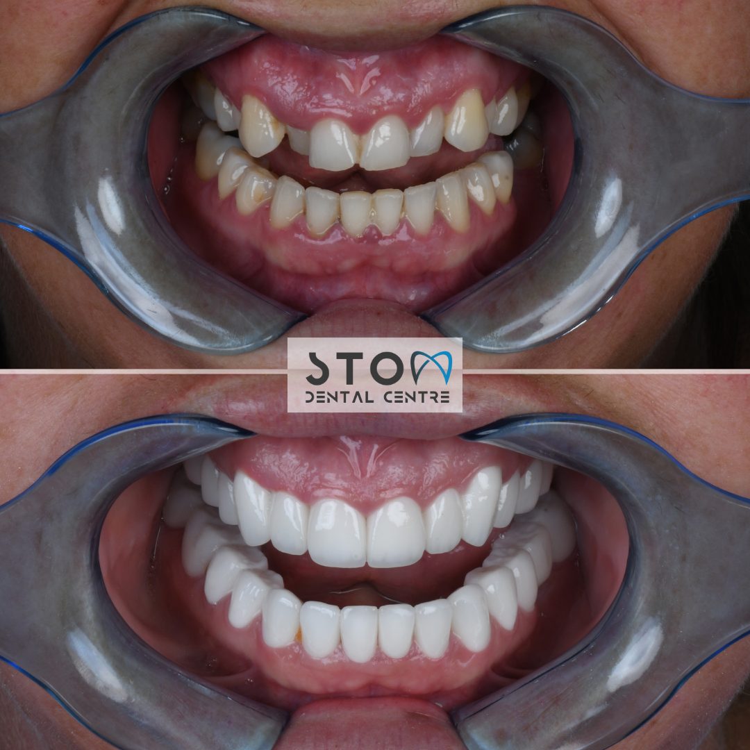 E-max Veneers — Real Results