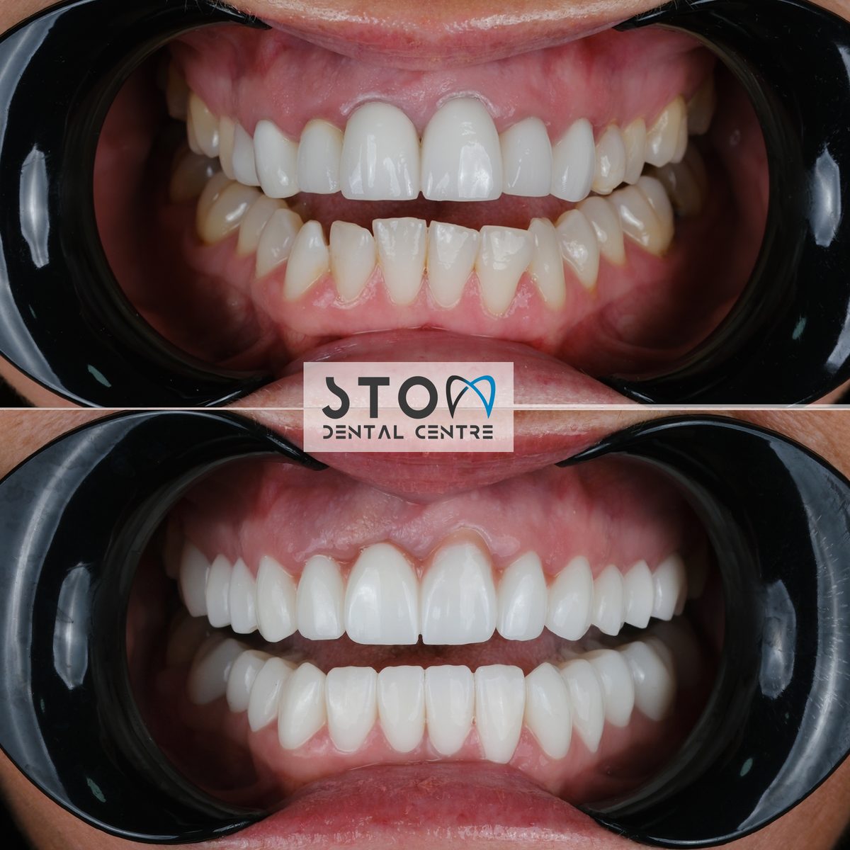 Zirconia Crowns — Real Results