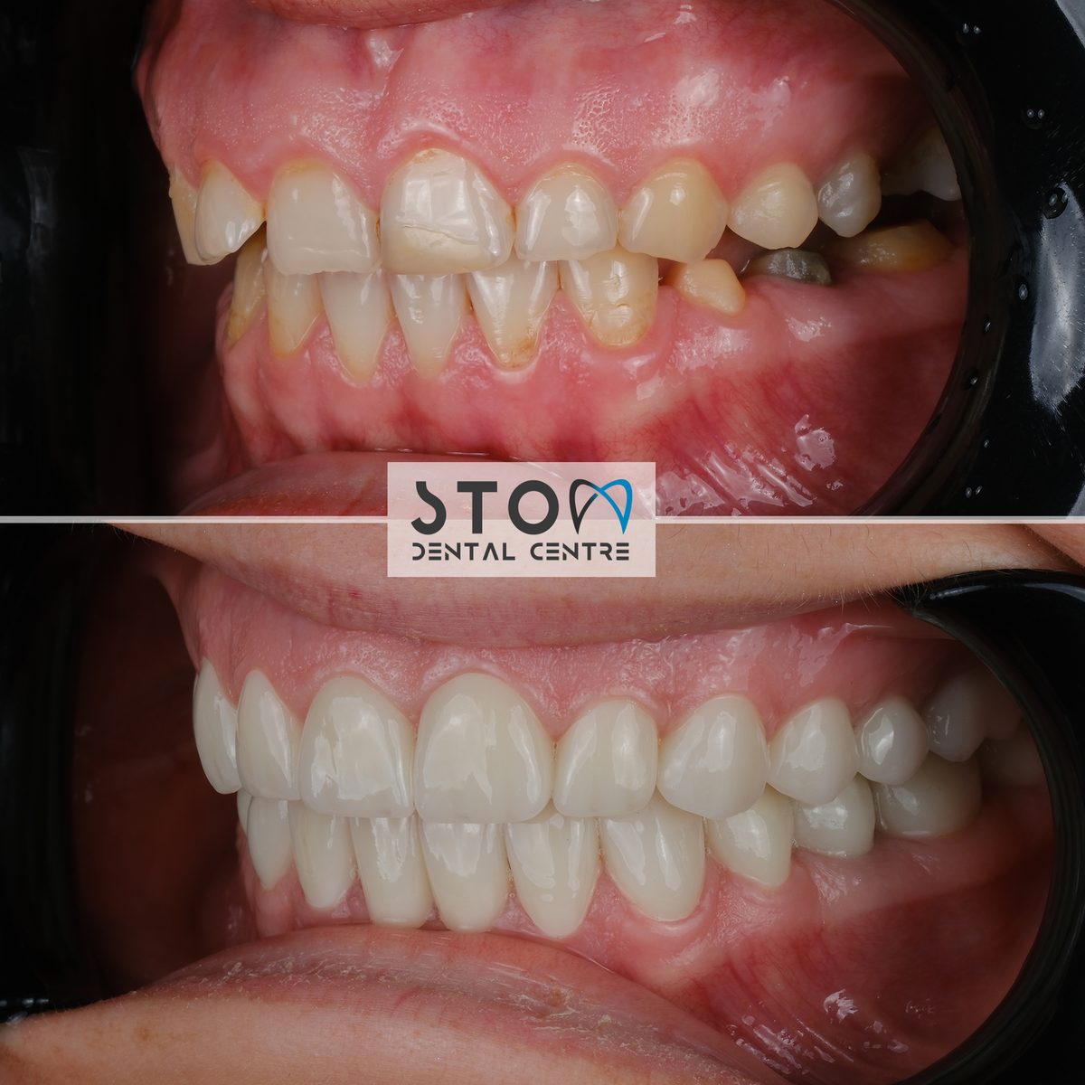 Hollywood Smile — Real Results