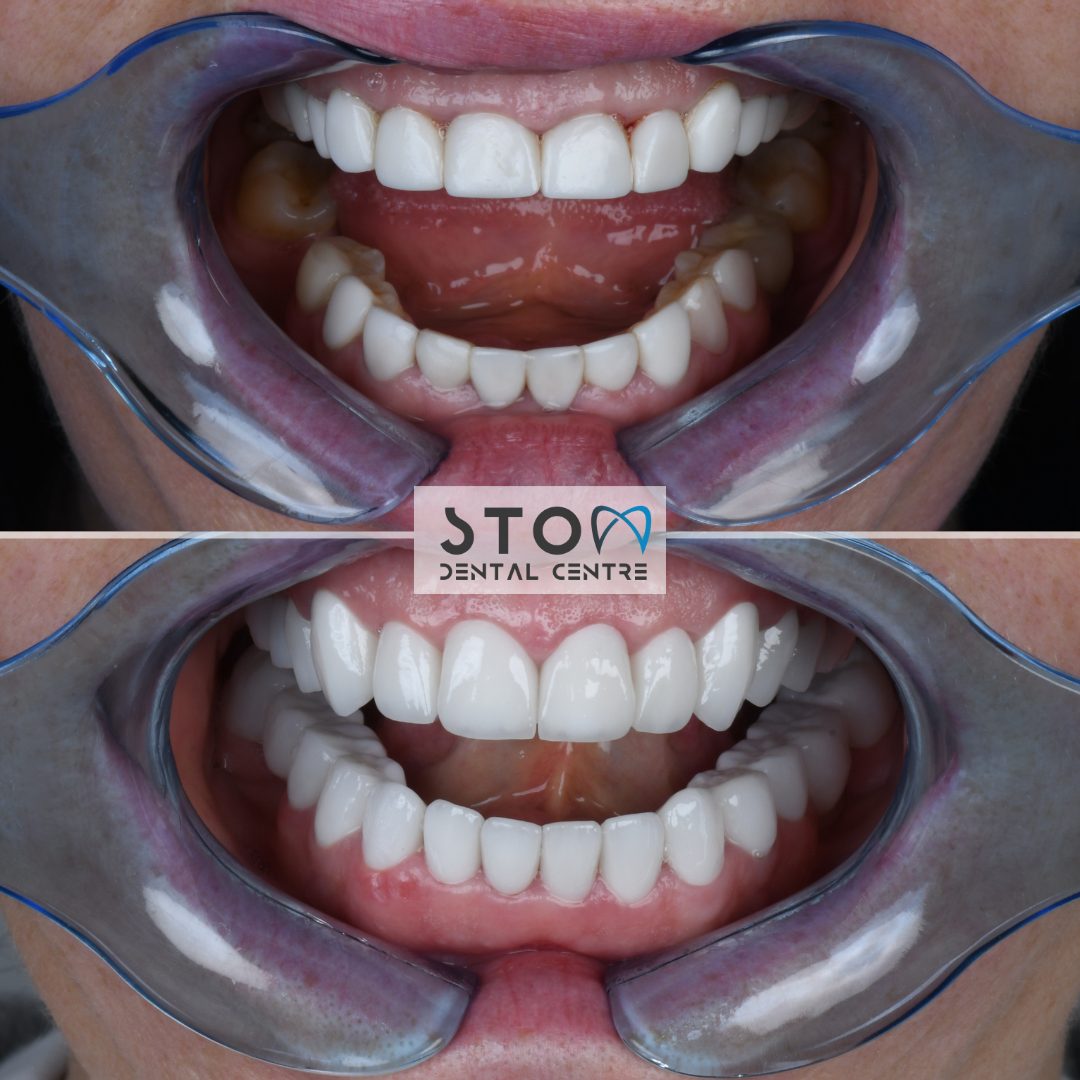 E-max Veneers — Real Results