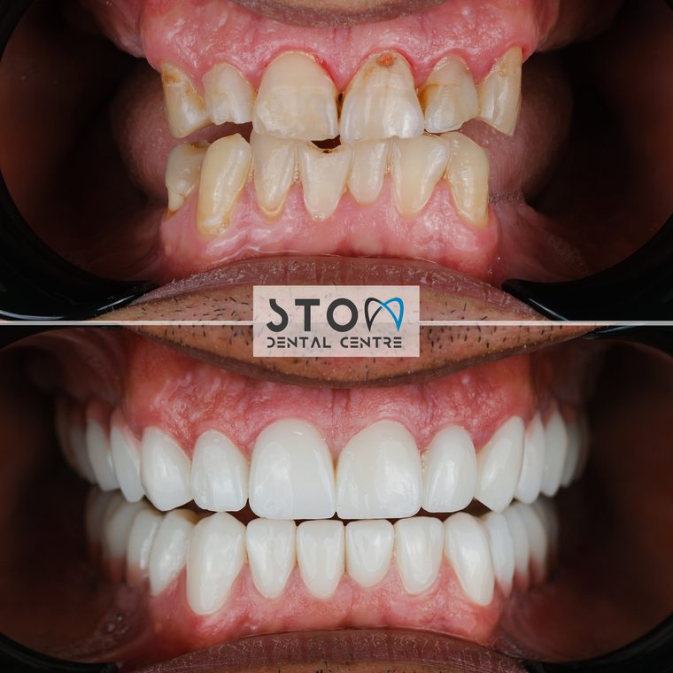 Full Mouth Reconstruction — Real Results