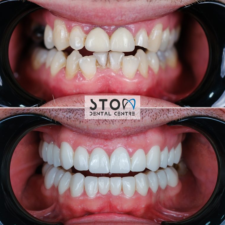 Hollywood Smile — Real Results