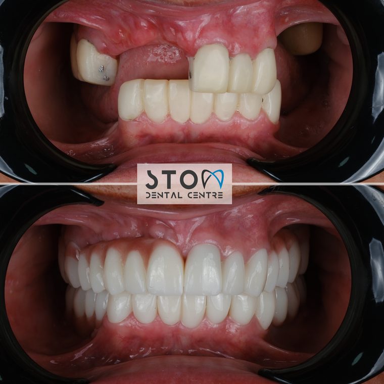 Zirconia Crowns — Real Results