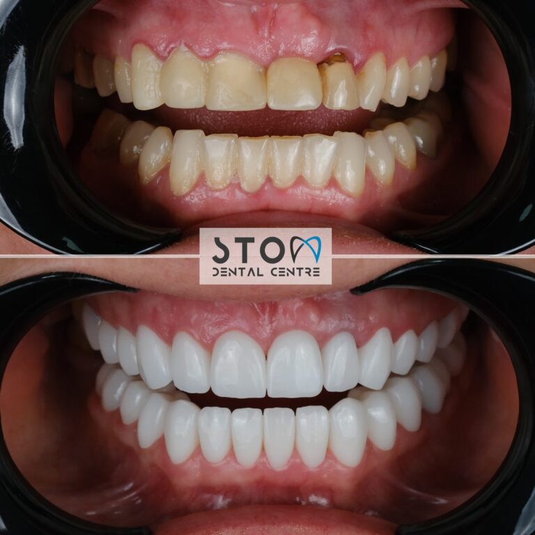 Composite Bonding Turkey 2026: Cost, vs Veneers & Lifespan