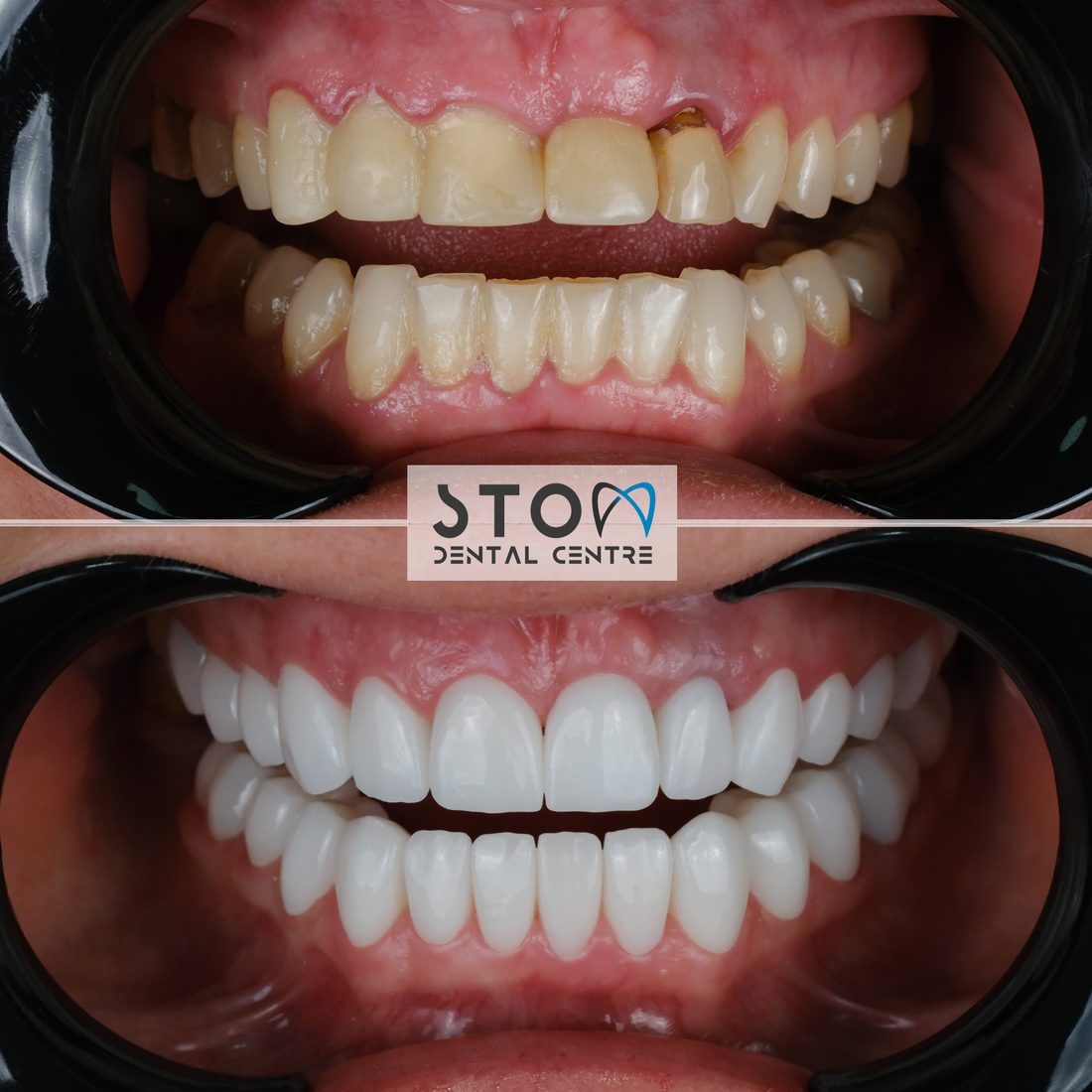 Composite bonding before and after Stom Dental Centre