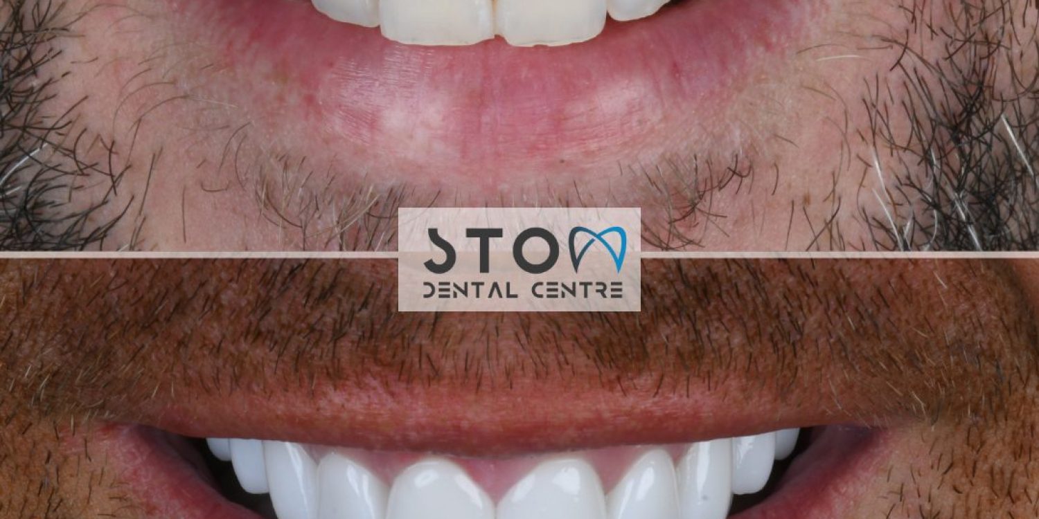 caprasik-dis-oncesi-sonrasi-stom-dental-antalya.jpg