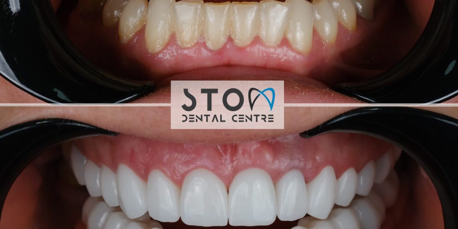Composite bonding before and after Stom Dental Centre