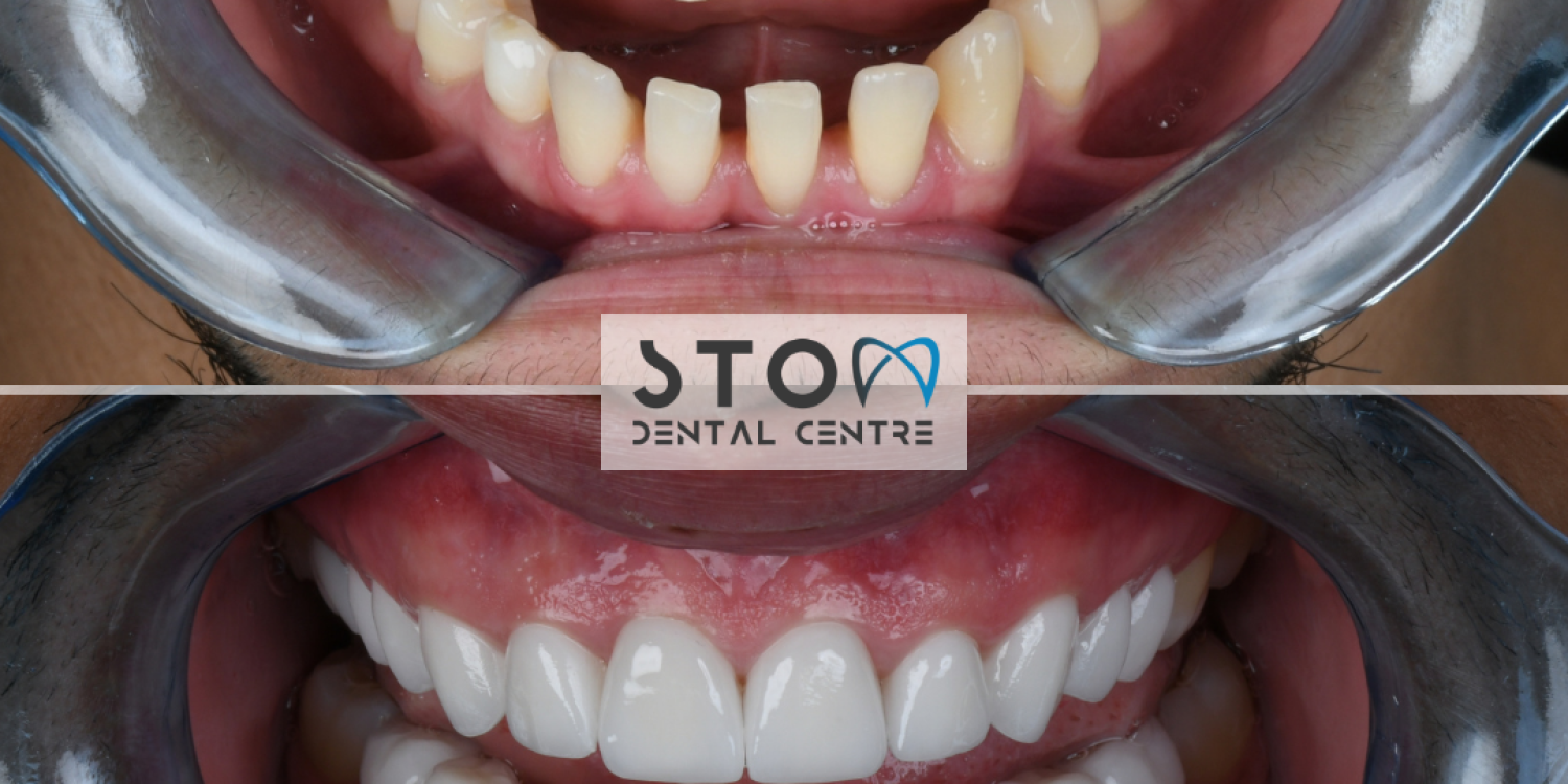 Before and after dental calculus cleaning at Stom Dental Centre Antalya