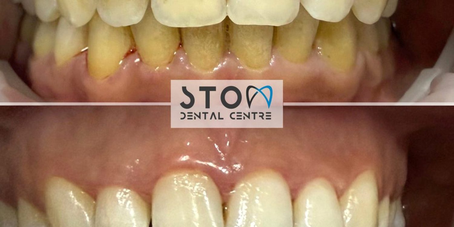 dis-beyazlatma-oncesi-sonrasi-stom-dental-antalya.jpg