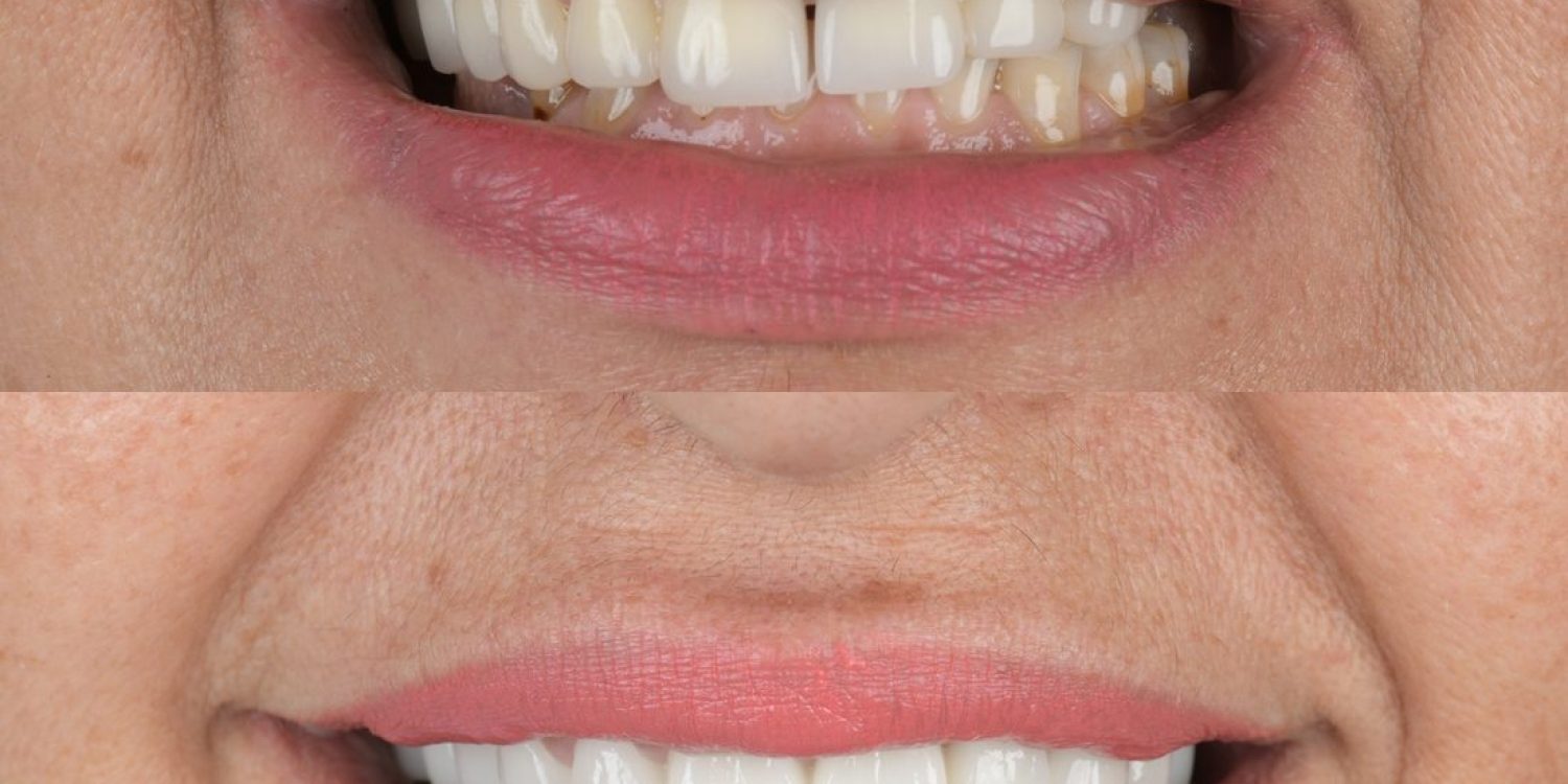 emax-lamine-oncesi-sonrasi-stom-dental-antalya.jpg