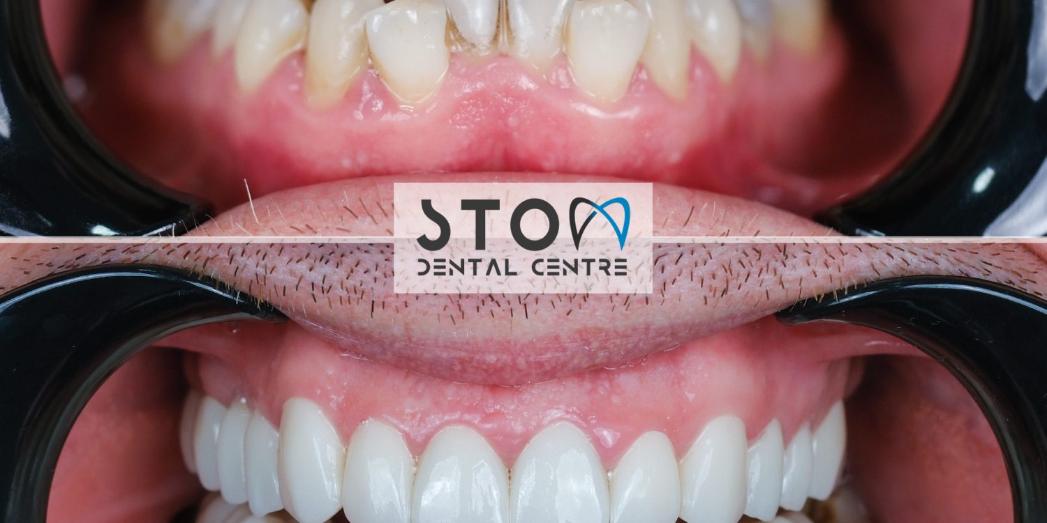 Hollywood smile veneer before and after at Stom Dental Centre Antalya