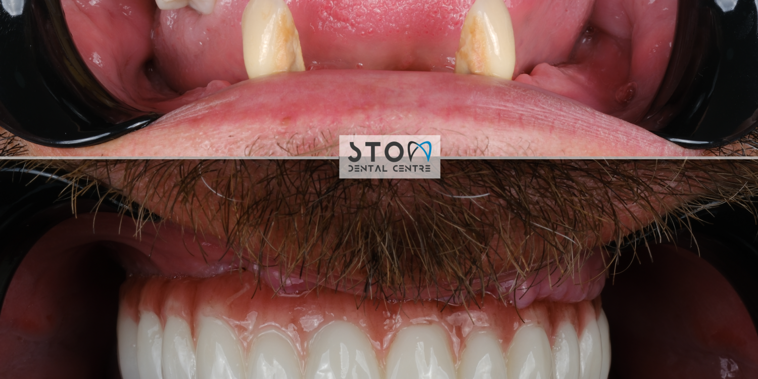 Dental implant before and after transformation at Stom Dental Centre Antalya Turkey