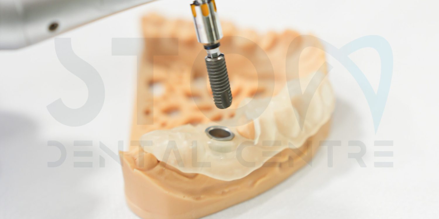 Dental treatment result at Stom Dental Centre