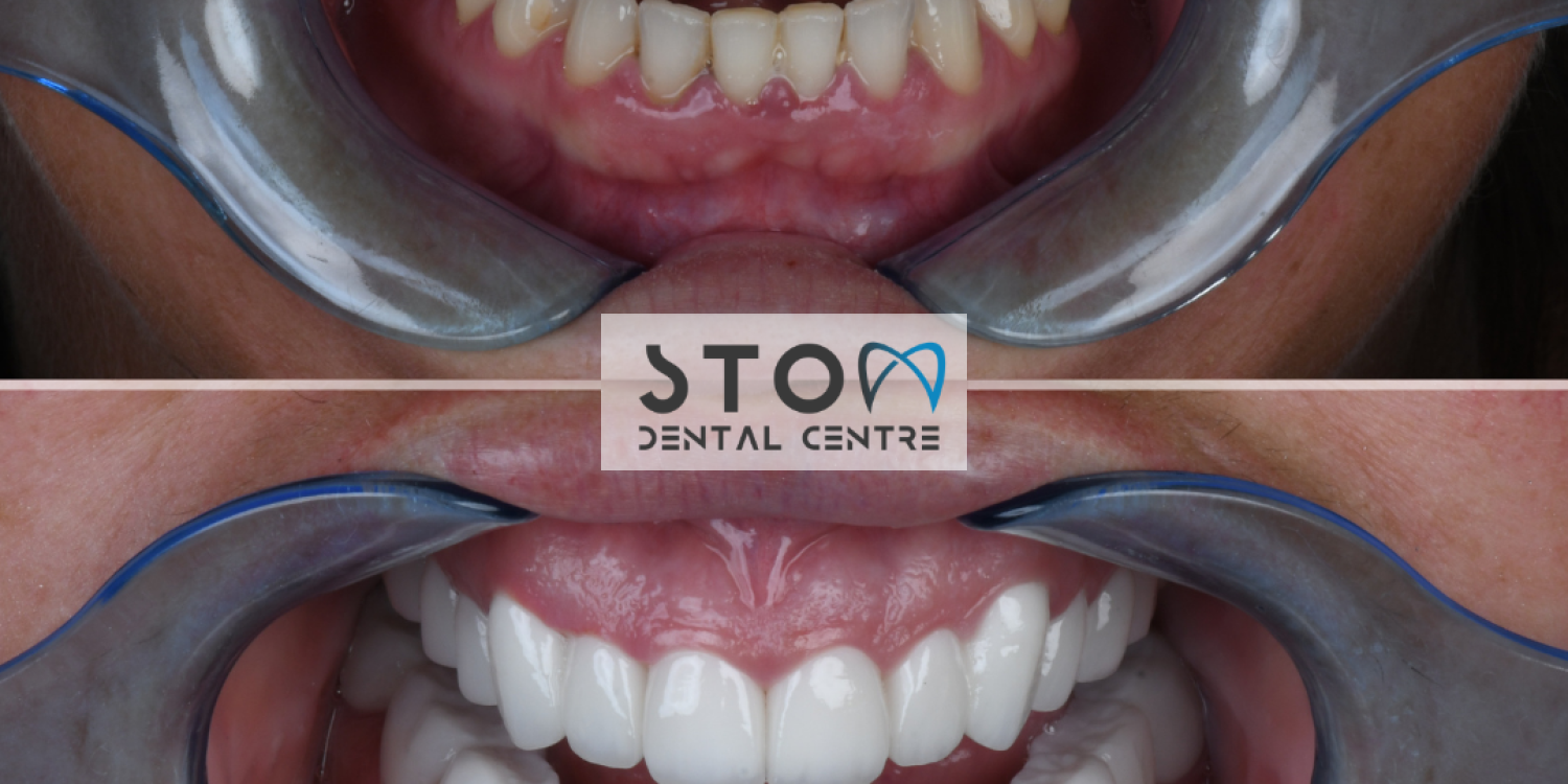 Smile makeover before and after with dental veneers at Stom Dental Centre