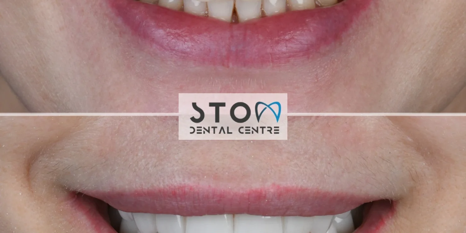 Before and after dental treatment at Stom Dental Centre Antalya, patient case 10