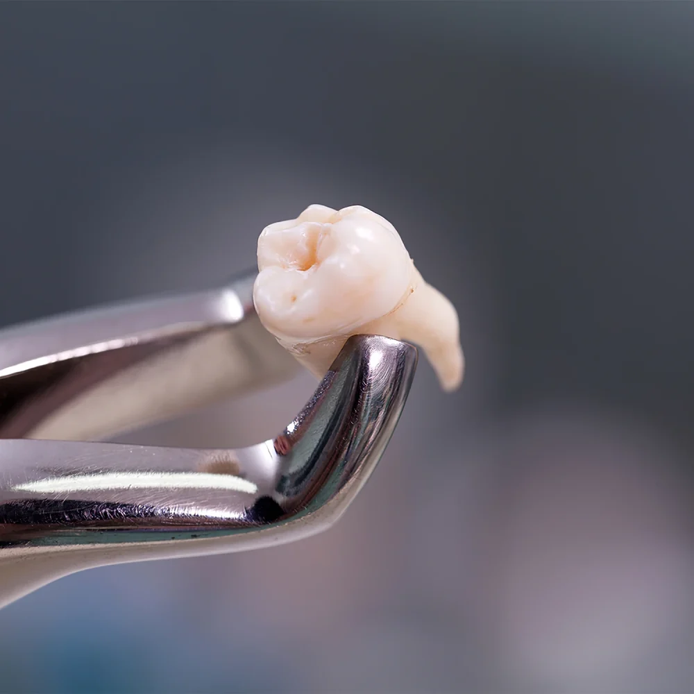stom-dental-centre-dislerin-normal-ve-cerrahi-cekilmesi