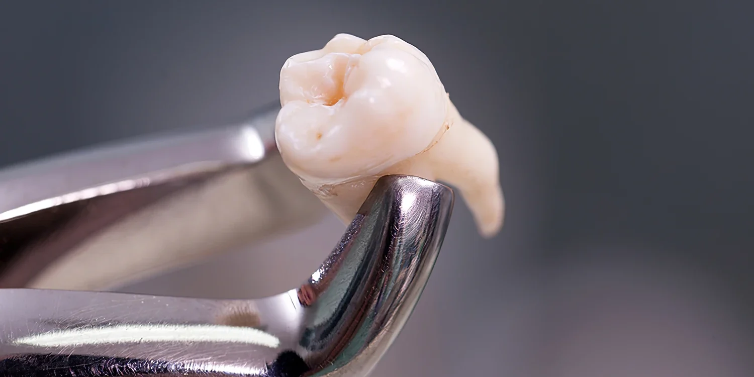 stom-dental-centre-dislerin-normal-ve-cerrahi-cekilmesi