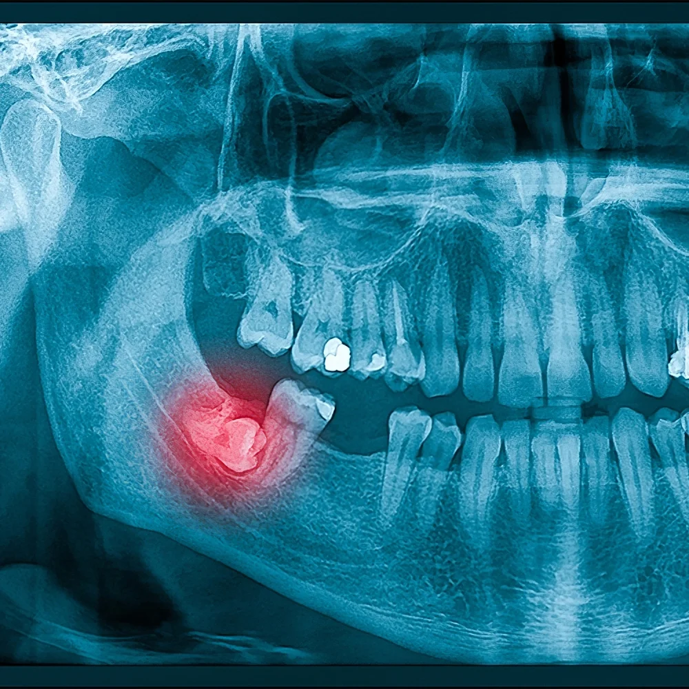 stom-dental-centre-gomulu-dis-operasyonu
