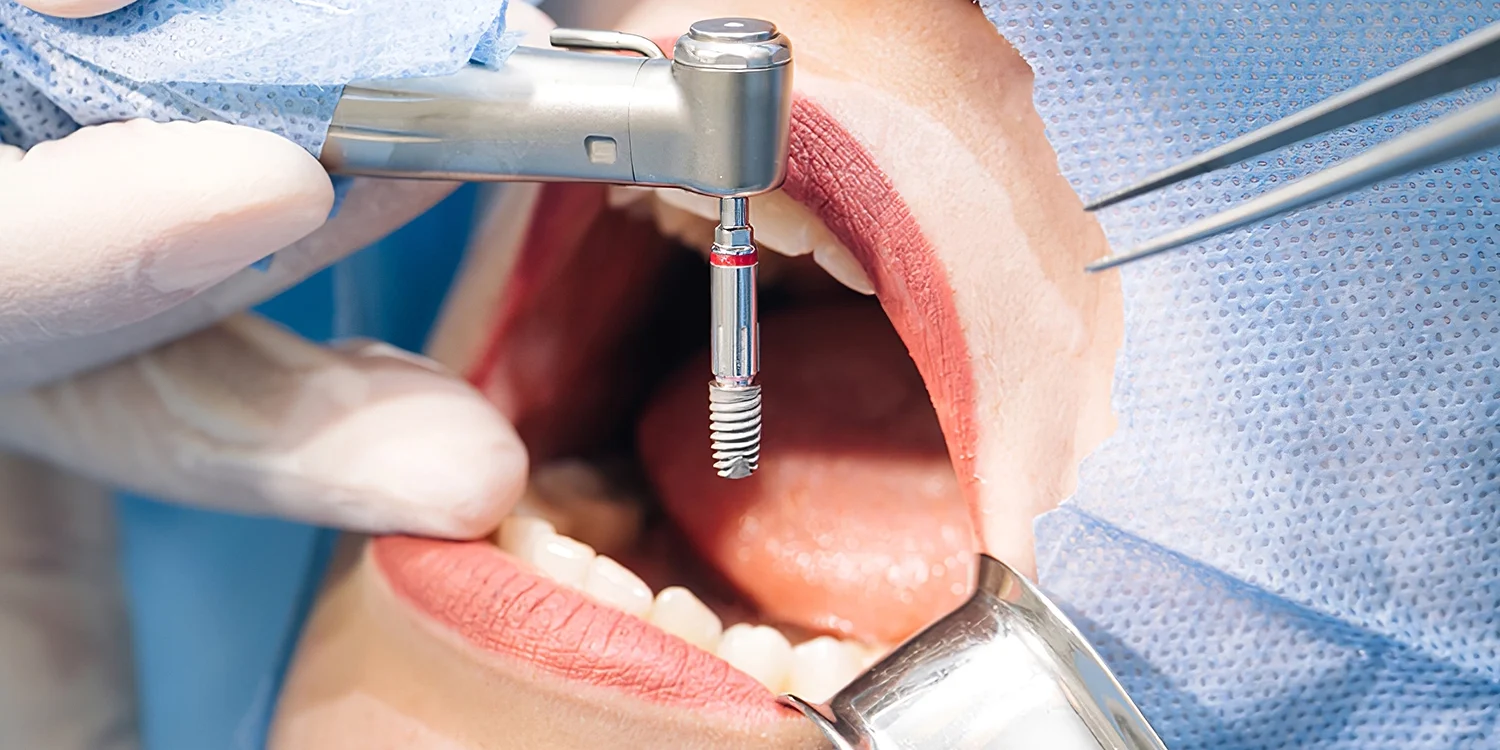 stom-dental-centre-implant-ve-ileri-implant-cerrahisi