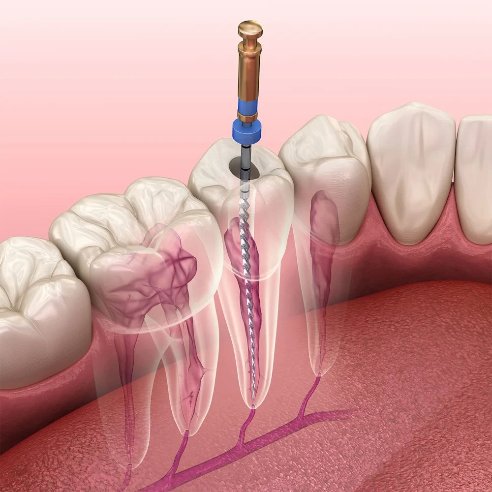 stom-dental-centre-kanal-tedavisi