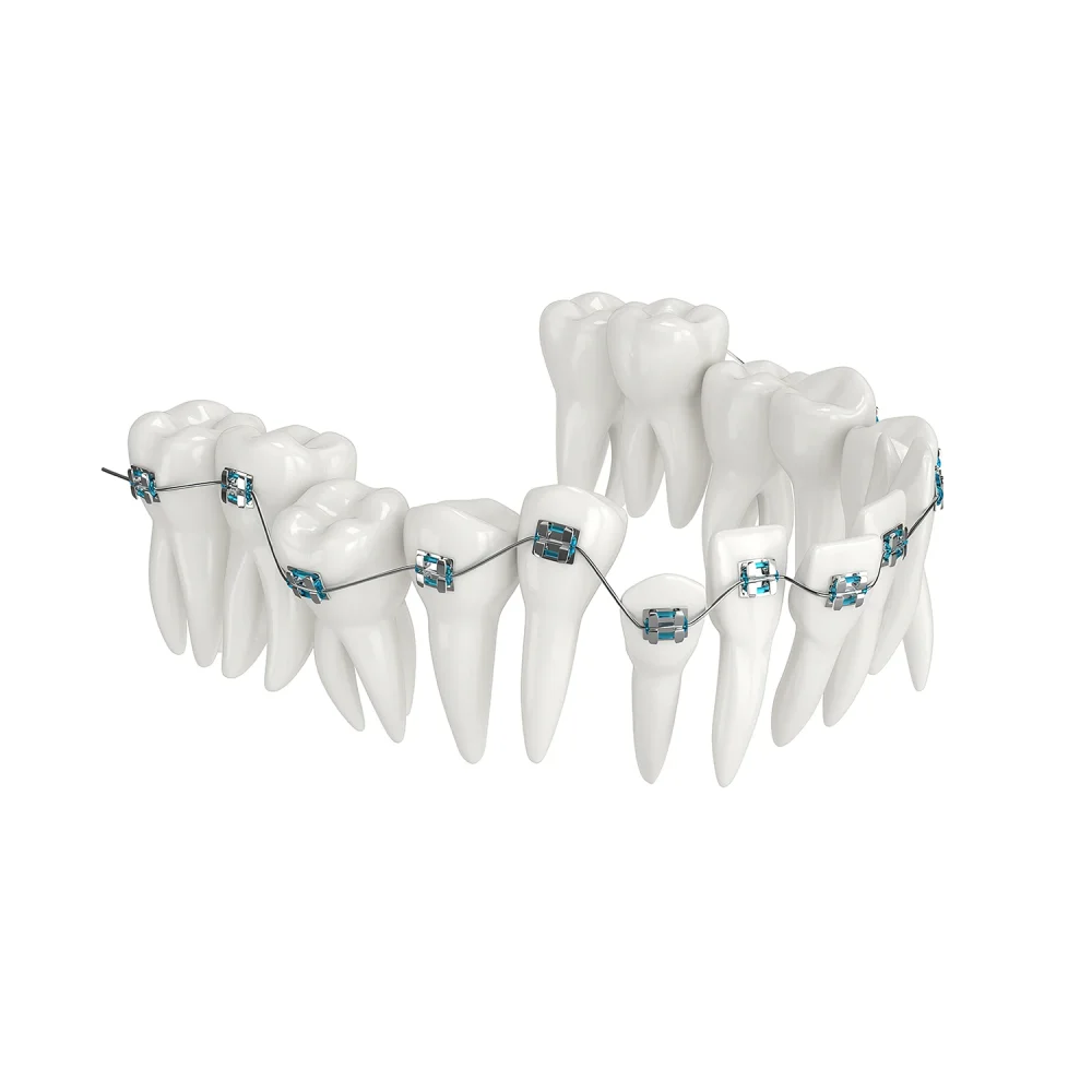 stom-dental-centre-klasik-sabit-ortodonti-tedavisi