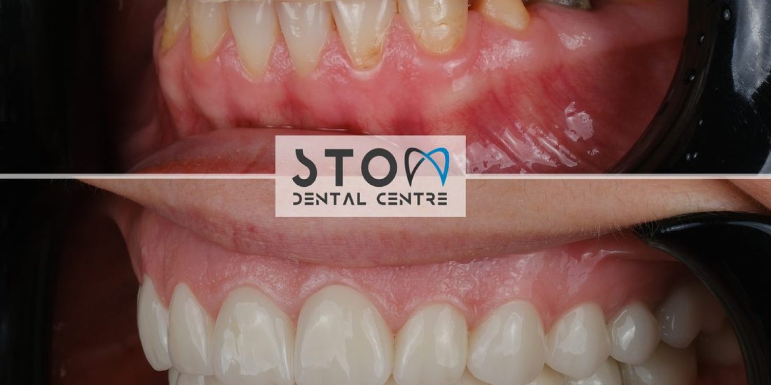 Zirconia crowns before and after