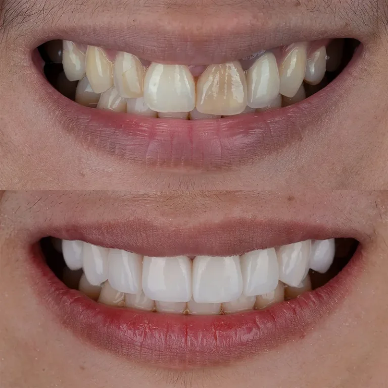 Diastema Explained: How to Close a Gap Between Your Front Teeth