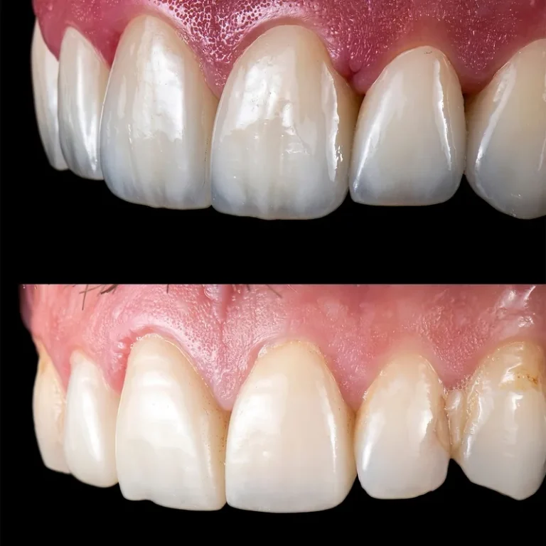 E-max vs Zirconia: Which Crown Material Is Right for Which Tooth?