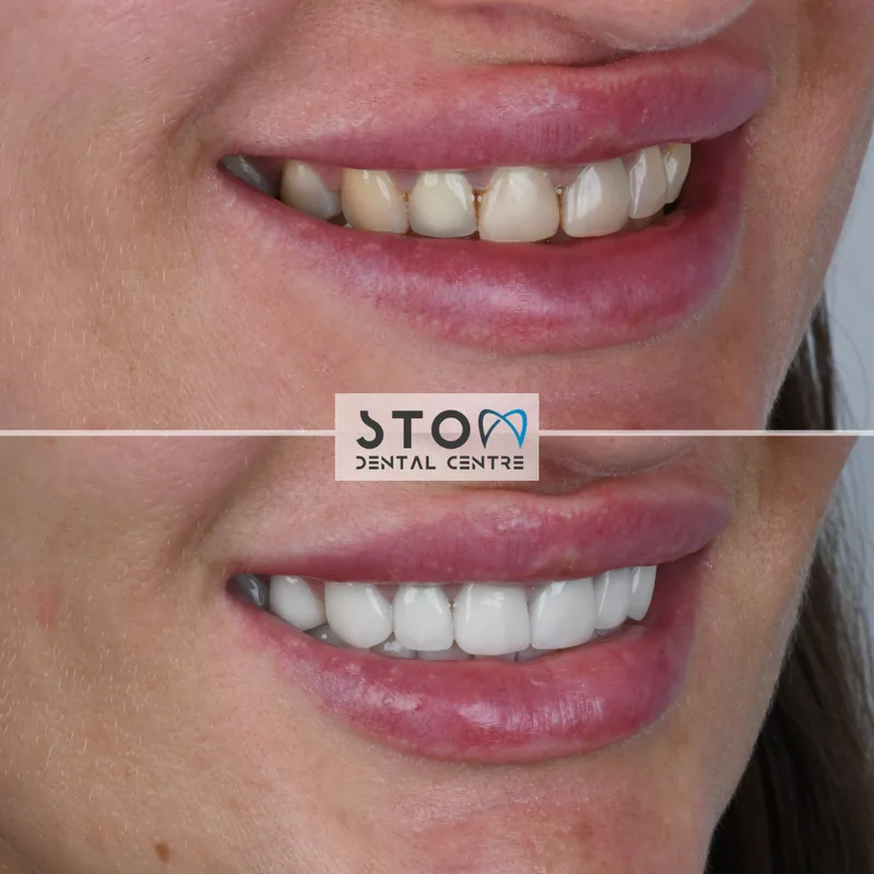 Patient case: smile before and after treatment