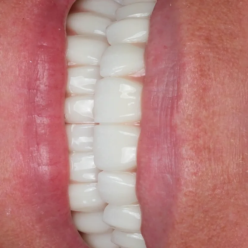 Finished zirconia restoration in the mouth, close-up